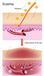 Imavita / Atopic Dermatitis
