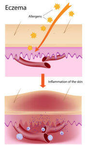 Schematic of atopic dermatitis (eczema) skin pathology