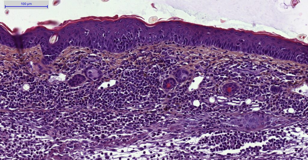 IL-23 induced Psoriasis Mouse Model